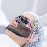 CARBON LASER FACIAL